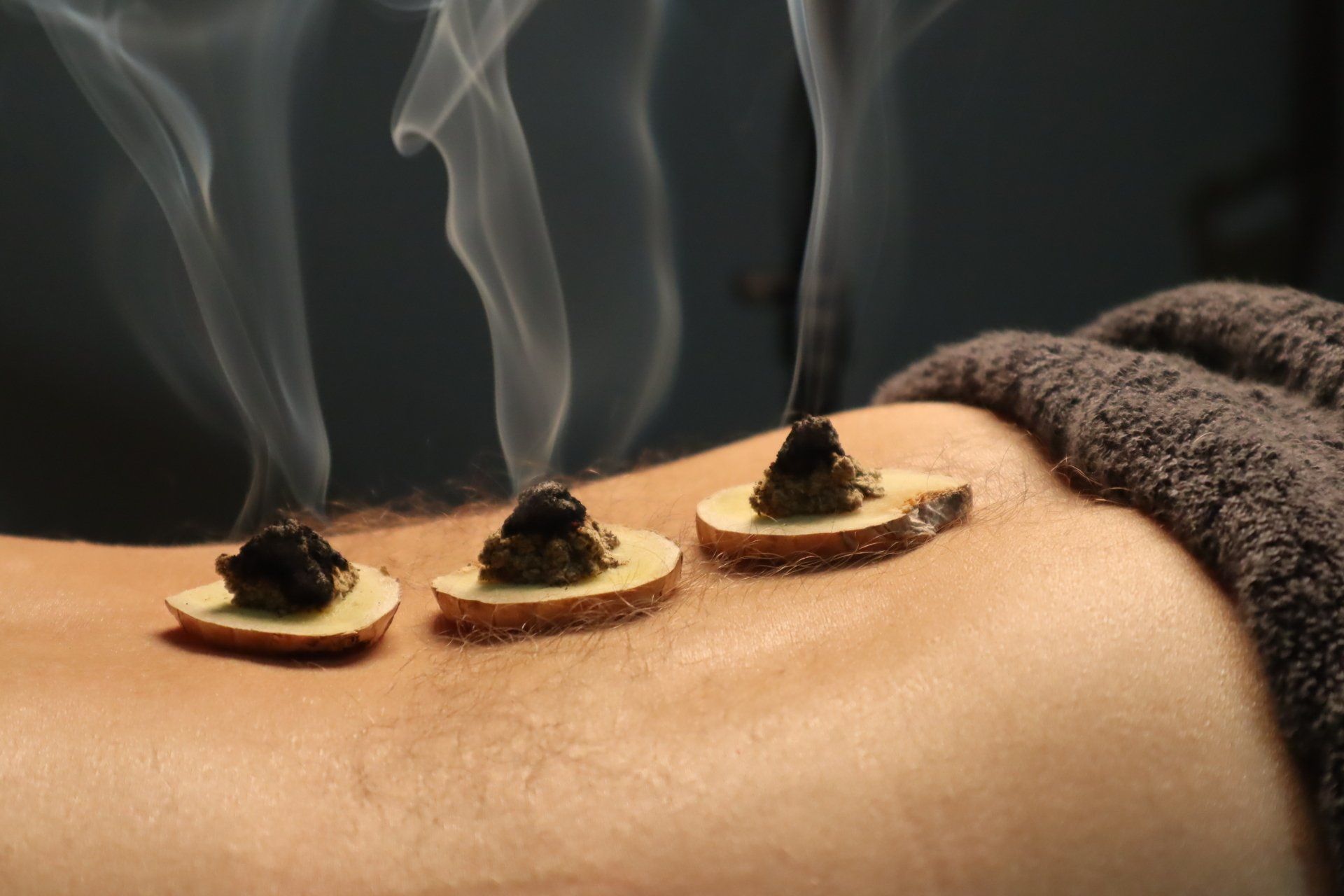 Three lit moxibustion cups on skin with smoke rising, beside a folded towel